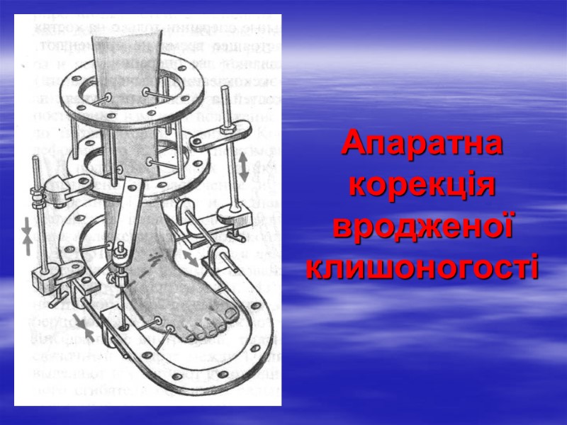 Апаратна корекція вродженої клишоногості